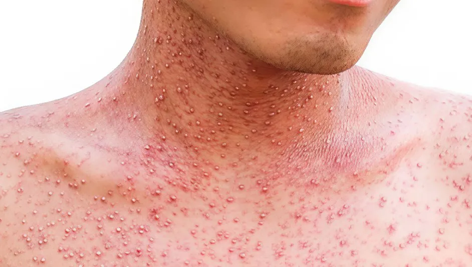 Aumentan a siete los casos confirmados de sarampión en Hidalgo